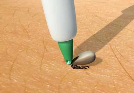 Trix Tick Lasso – Precision Removal Tool with Ergonomic Grip, Versatile for All Sizes