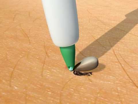 Trix Tick Lasso – Precision Removal Tool with Ergonomic Grip, Versatile for All Sizes